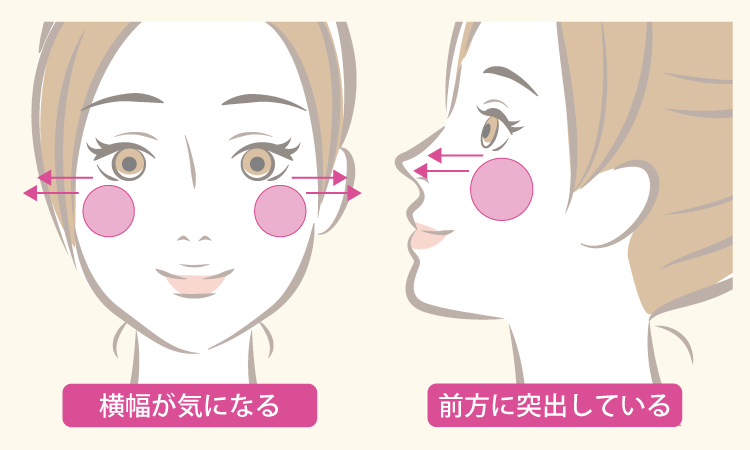 頬骨削り手術ポイントイメージ