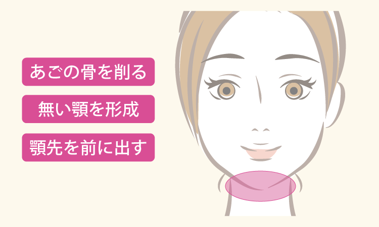 あご骨切り手術／オトガイ形成手術ポイントイメージ