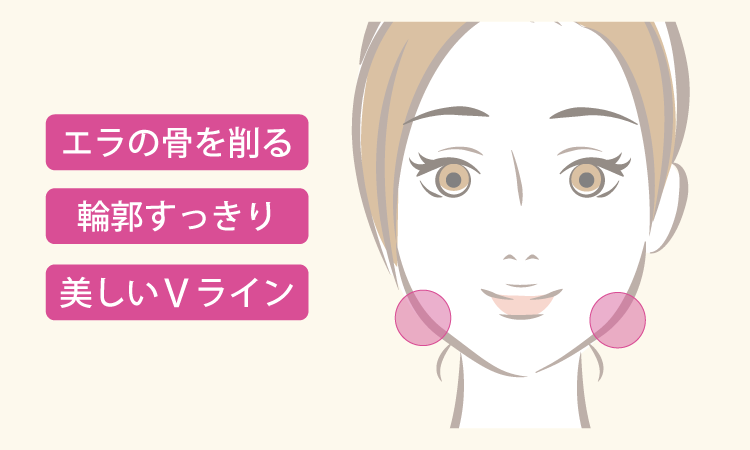 エラ削り手術ポイントイメージ